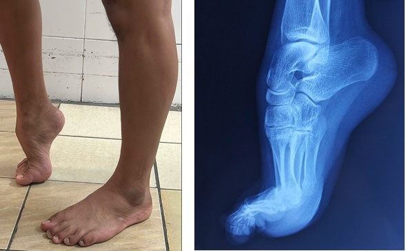 BV Trường ĐH Y Dược Huế phẫu thuật thành công ca bàn chân thuổng bẩm sinh ở người lớn